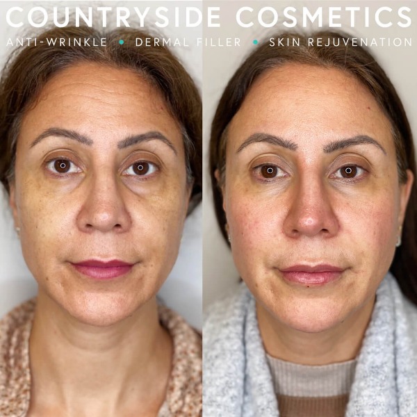 Facial rejuvenation and restoration with dermal fillers, performed at Countryside Cosmetics